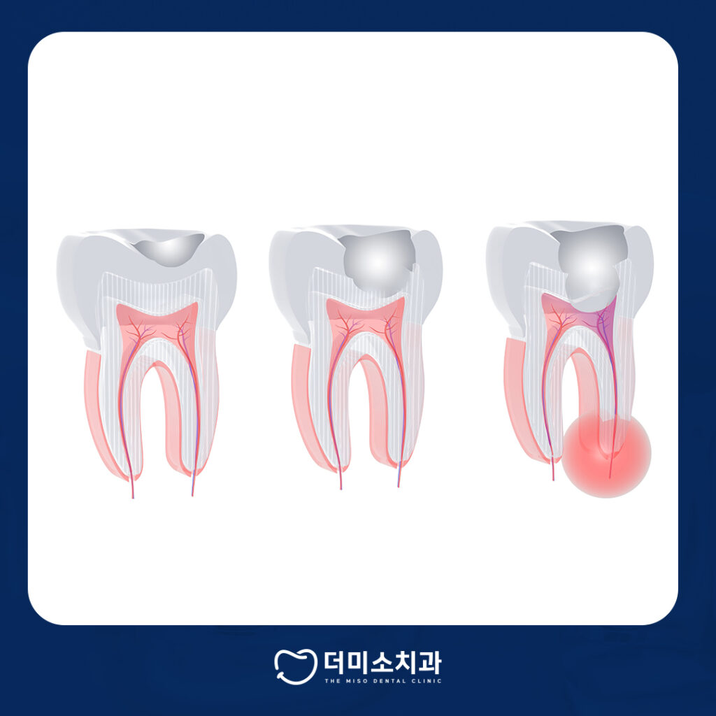 더미소치과 충치치료