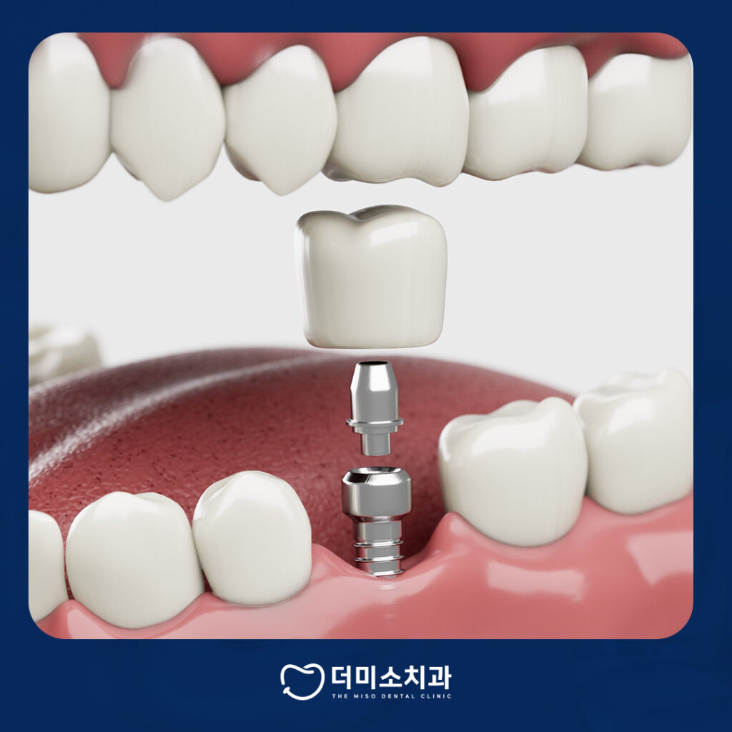 더미소치과 임플란트