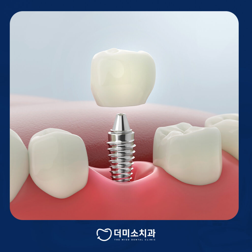 더미소치과 임플란트
