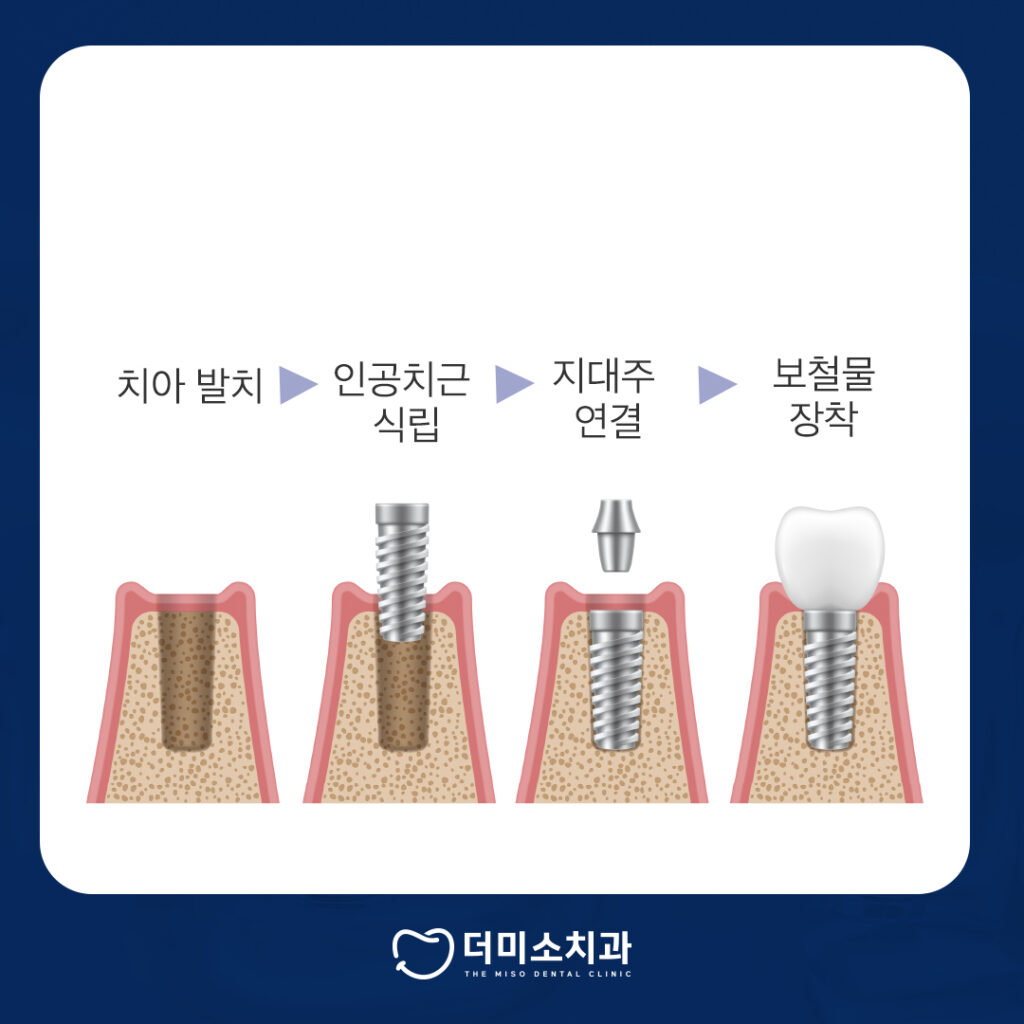 더미소치과 임플란트