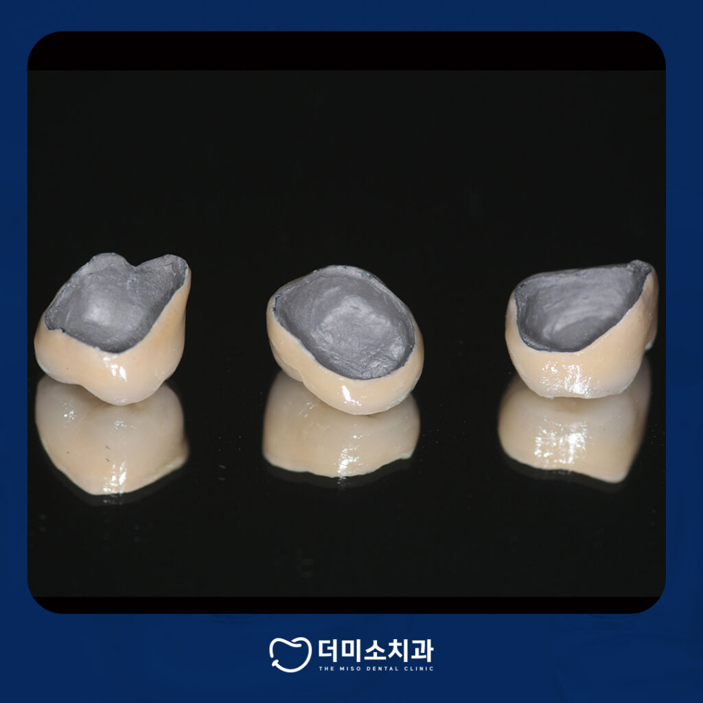 보철종류