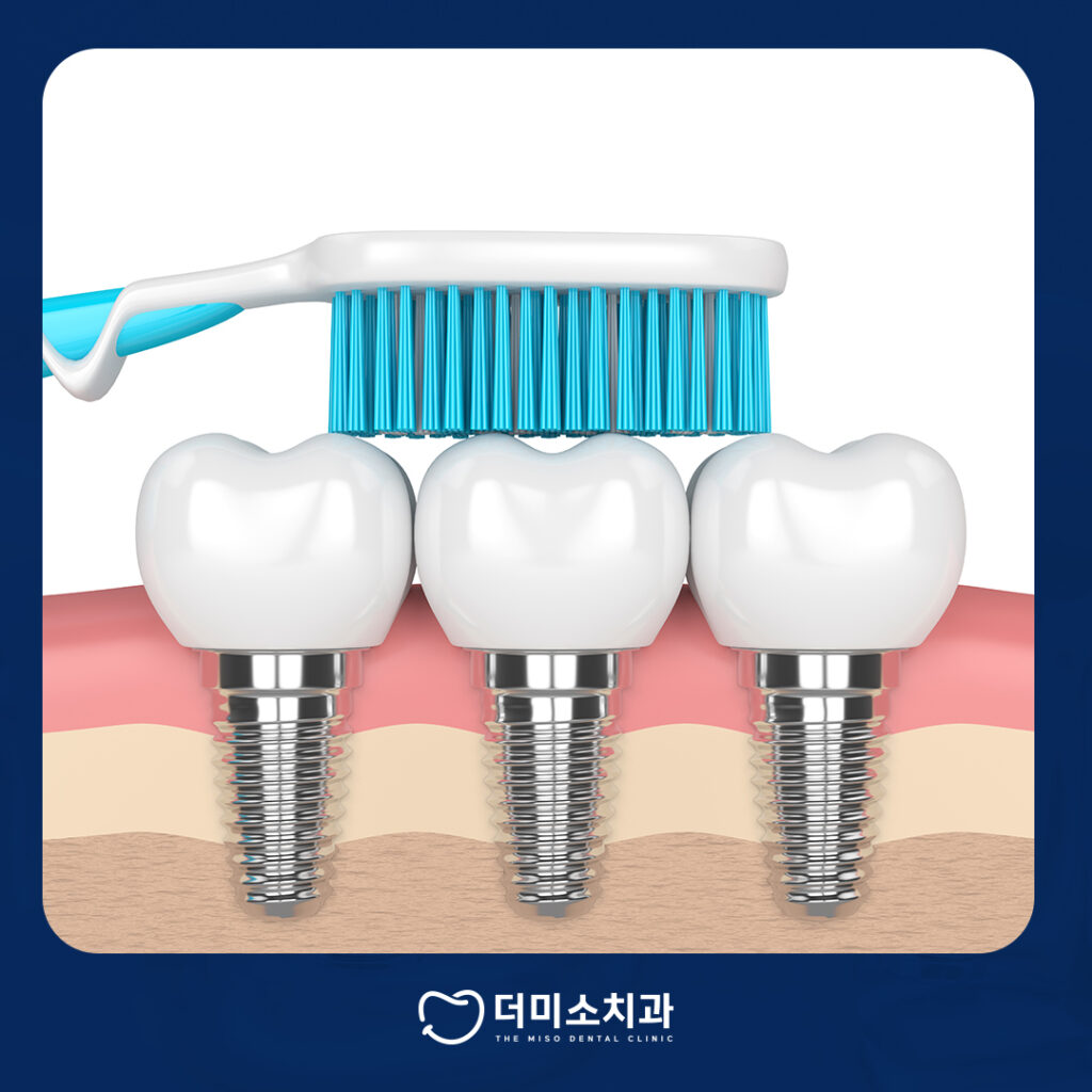 더미소치과 임플란트