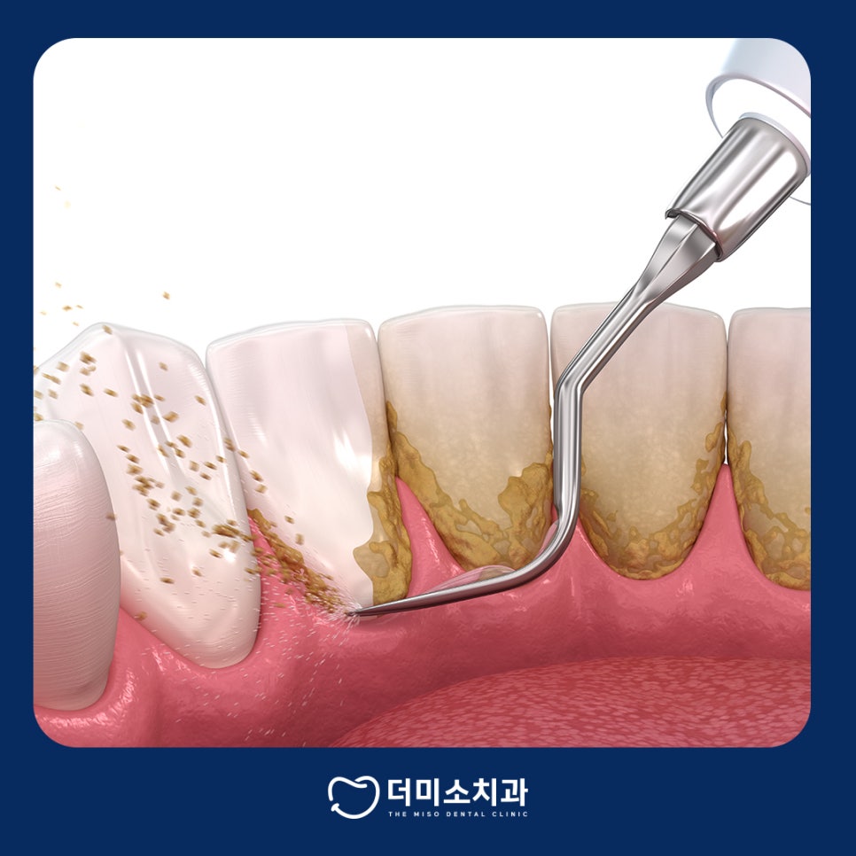 더미소치과 스케일링