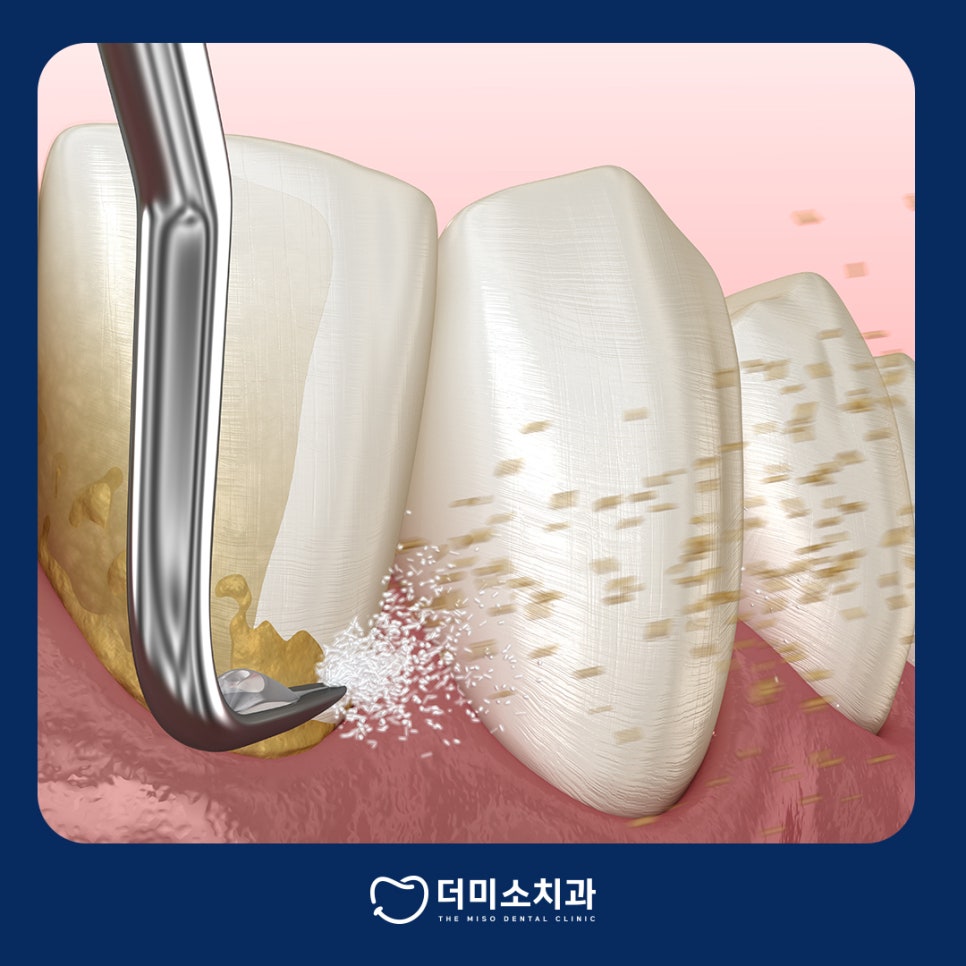 더미소치과 스케일링