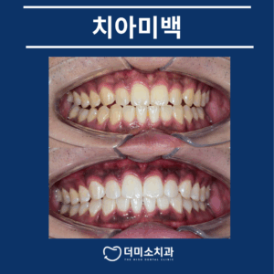 광명동치과 치아미백 타이틀