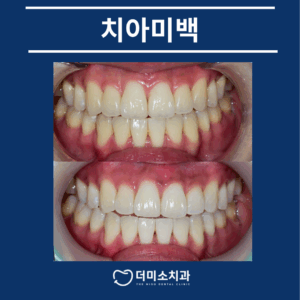광명동치아미백 치료 진행 타이틀