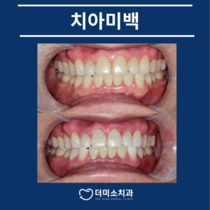 광명치과 치아미백치과 타이틀