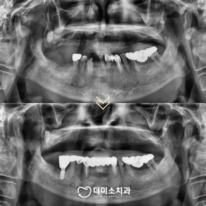 광명동임플란트 치료 전 과 후