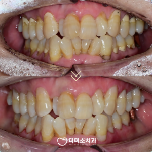 광명동치과 치료 전 후