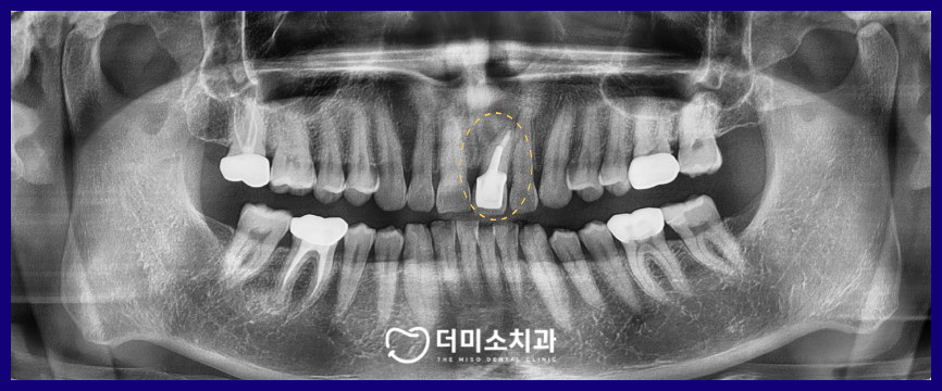 광명동임플란트