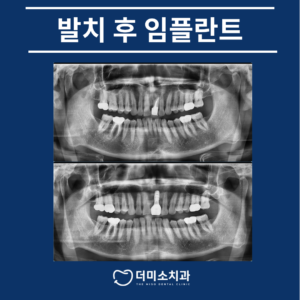 광명동임플란트