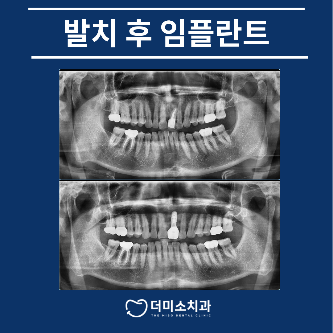 광명동임플란트