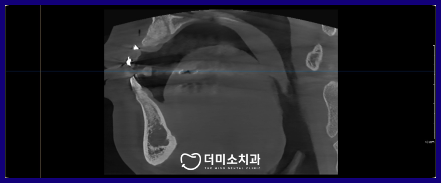 광명동임플란트