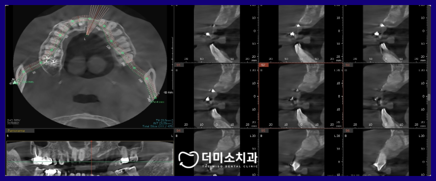 광명동임플란트