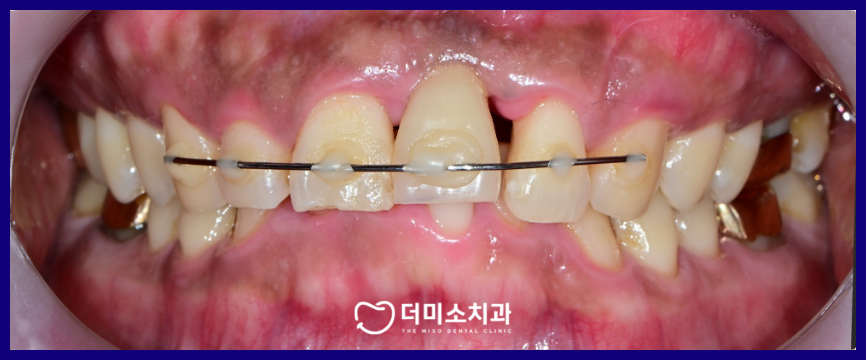 광명동임플란트