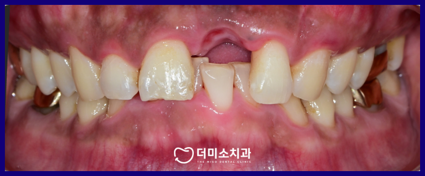 광명동임플란트
