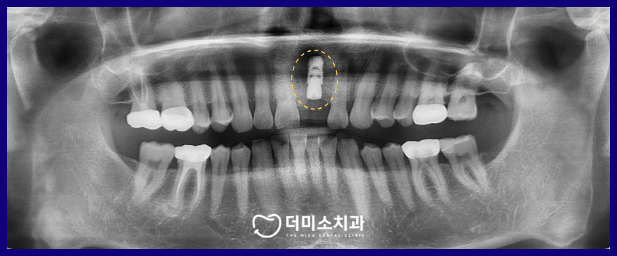 광명동임플란트