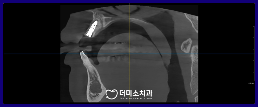 광명동임플란트