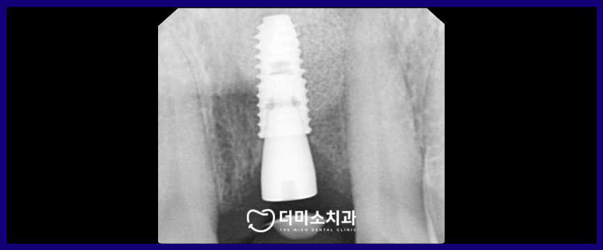 광명동임플란트