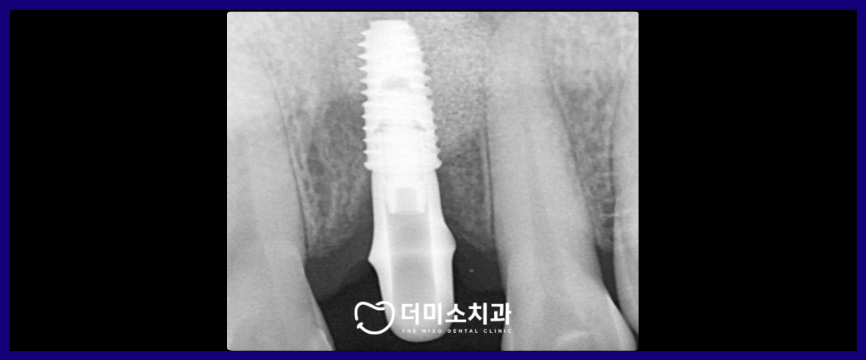 광명동임플란트