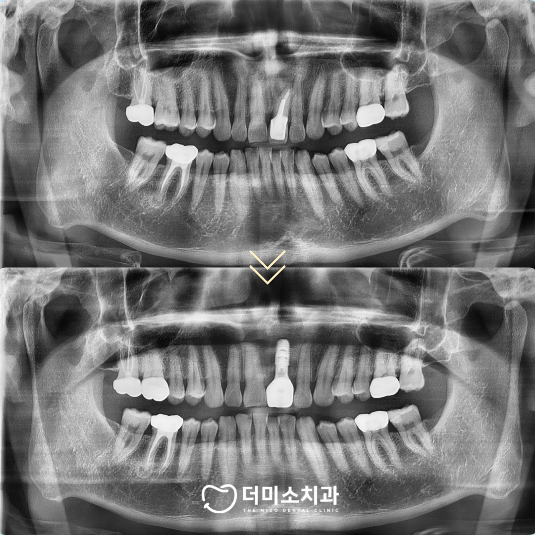 광명동임플란트