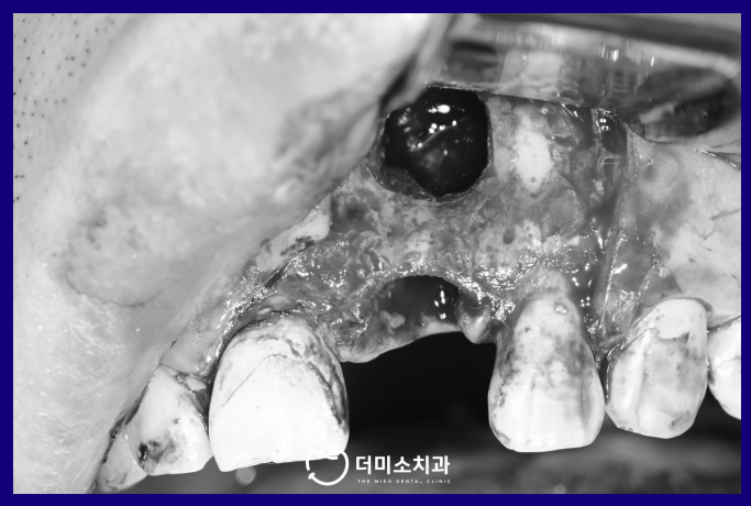광명동임플란트