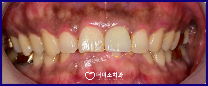 광명동임플란트