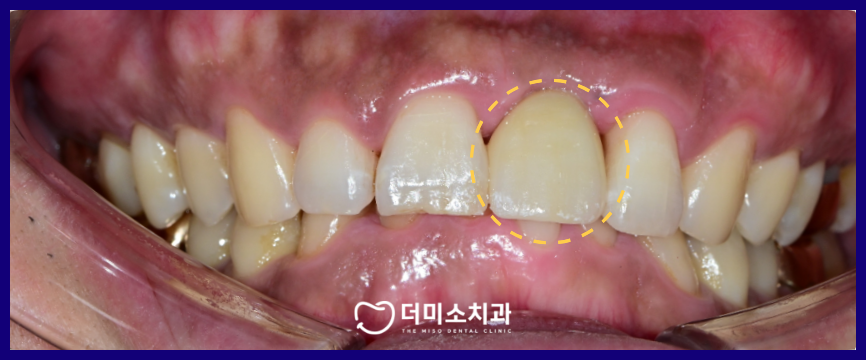 광명동임플란트