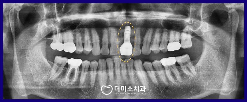 광명동임플란트