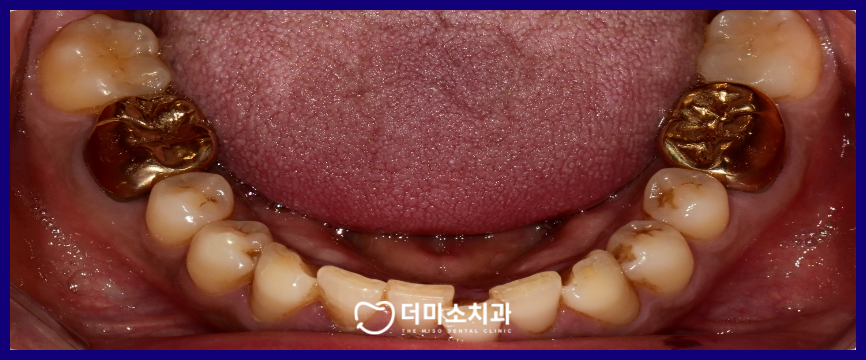광명동임플란트