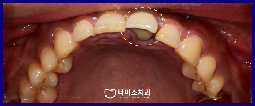 광명동임플란트